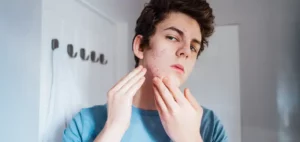 Benzoyl Peroxide-Free Acne Treatment Guide | Dermal Therapy