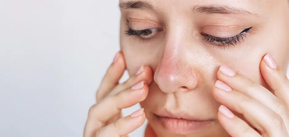Image of a woman touching her cheeks with both hands, she has a slightly red nose and image indicates model has sensitive skin