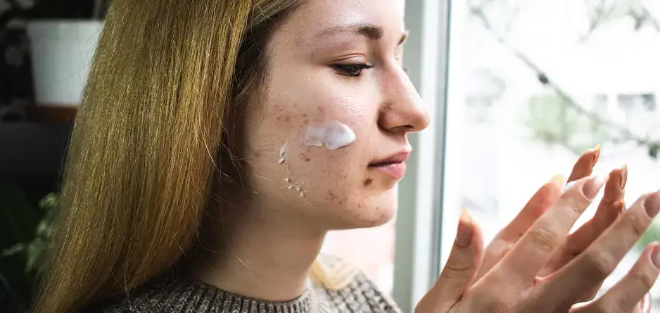 A woman applying Dermal Therapy Acne Cream wondering why Acne Doesn’t Stop in Winter And How to Treat It Without Drying Out her Skin