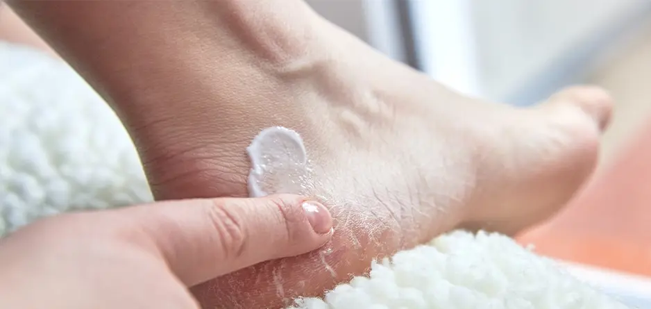 Rubbing cream on cracked heels