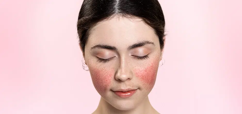 Woman with facial redness
