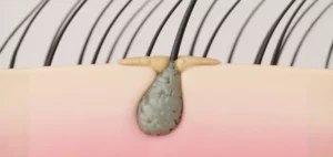 A hair root in a scalp showing scalp sebum build up