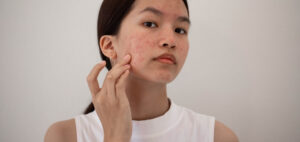 A girl with acne on her cheek touching it - thinking about acne treatment