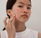 A girl with acne on her cheek touching it - thinking about acne treatment