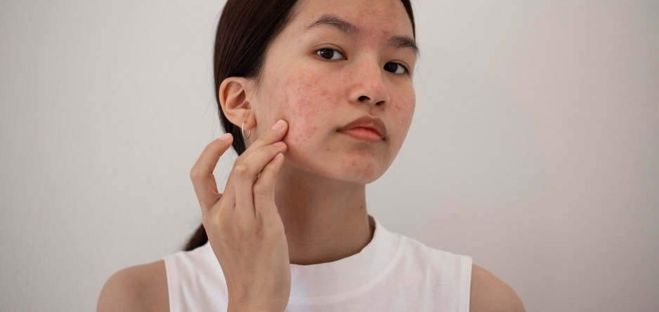 A girl with acne on her cheek touching it - thinking about acne treatment