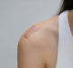A woman in a white vest with a scar on her shoulder - thinking about improved scar management
